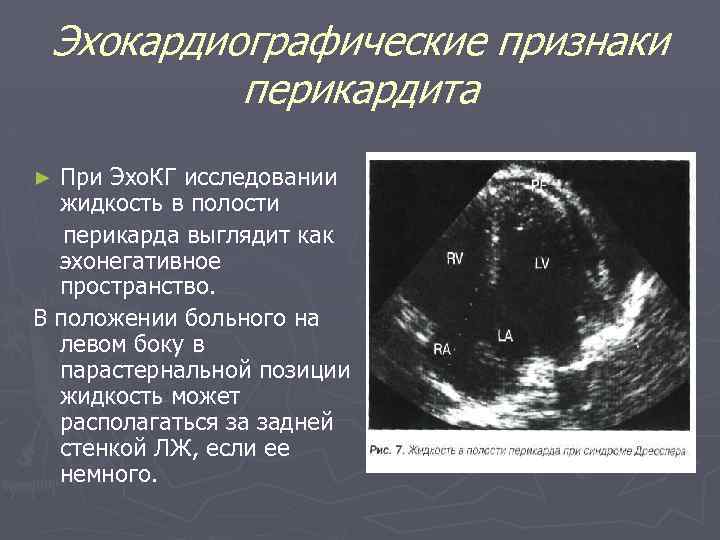 Эхокардиографические признаки перикардита При Эхо. КГ исследовании жидкость в полости перикарда выглядит как эхонегативное