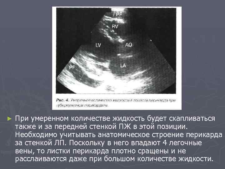 ► При умеренном количестве жидкость будет скапливаться также и за передней стенкой ПЖ в
