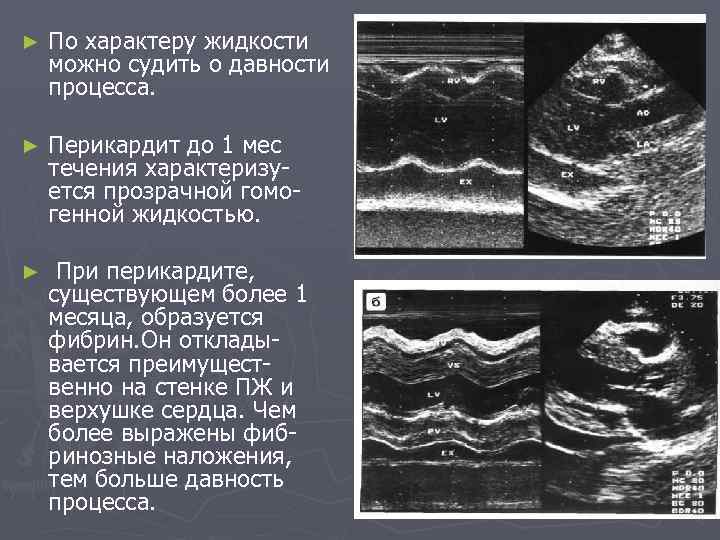 ► По характеру жидкости можно судить о давности процесса. ► Перикардит до 1 мес