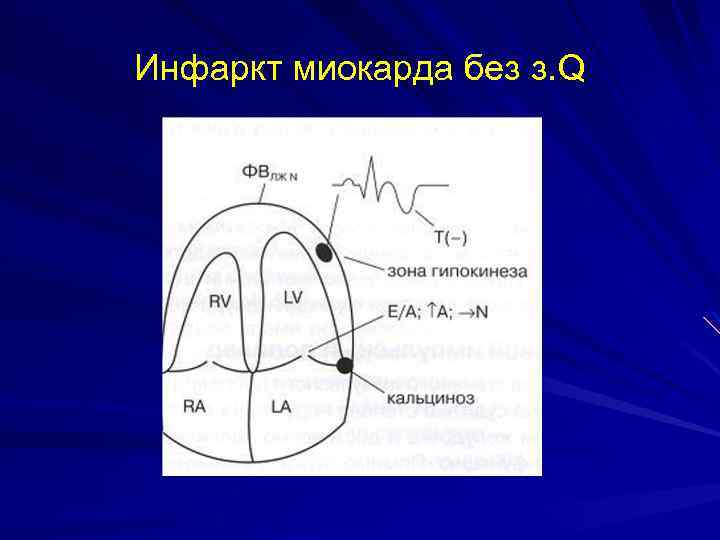 Инфаркт миокарда без з. Q 