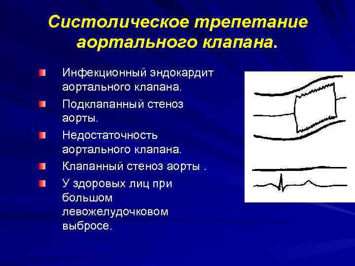 Порок аортального клапана мкб 10