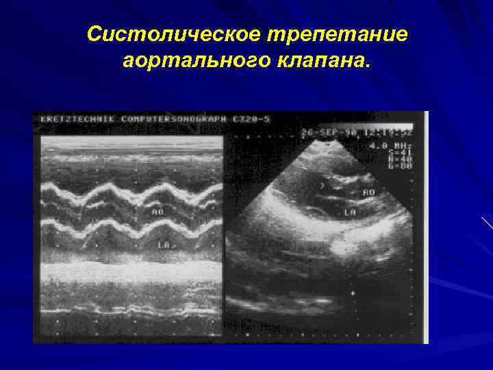 Аортальный клапан нормальные показатели