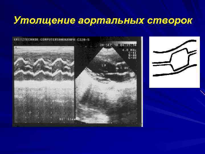 Расхождение створок аортального клапана