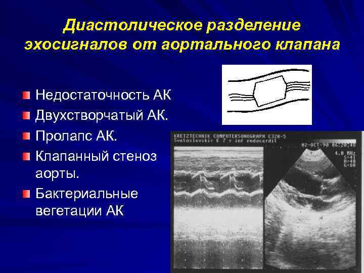 Что такое аортальный клапан