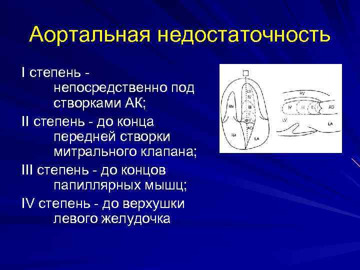 Аортальная недостаточность I степень непосредственно под створками АК; II степень - до конца передней