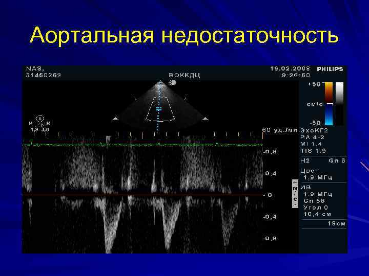 Аортальный клапан на узи