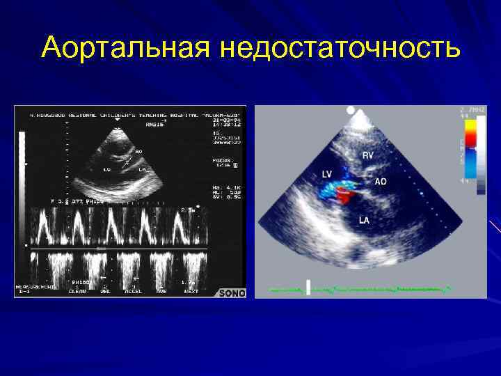 Аортальная недостаточность 