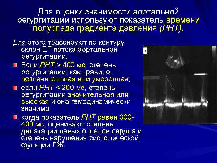 Для оценки значимости аортальной регургитации используют показатель времени полуспада градиента давления (РНТ). Для этого