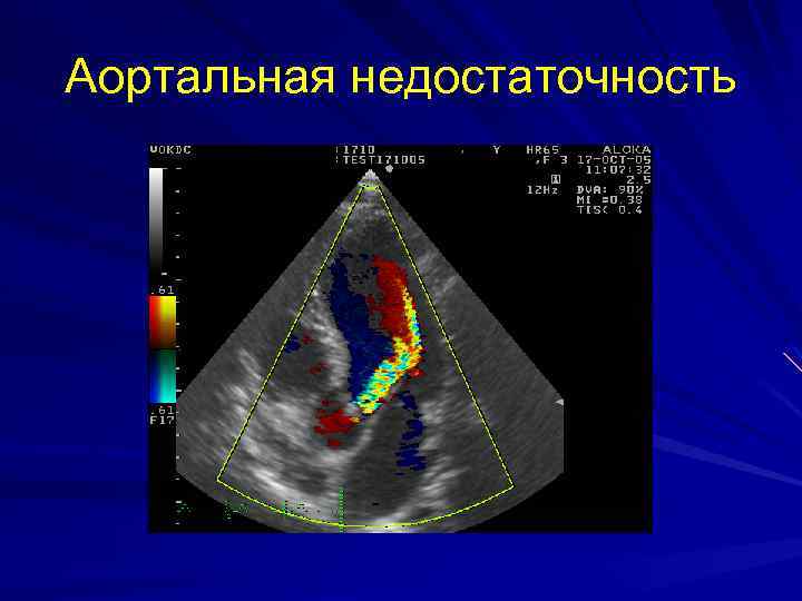 Аортальная недостаточность 
