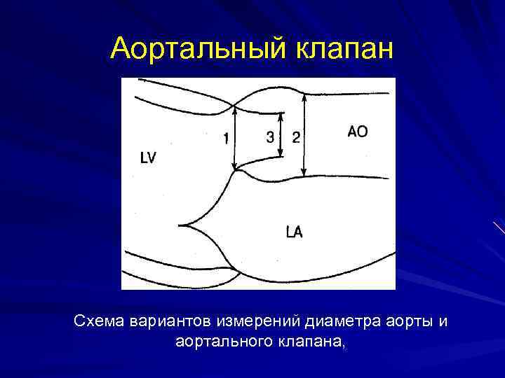 Бикуспидальный аортальный клапан это