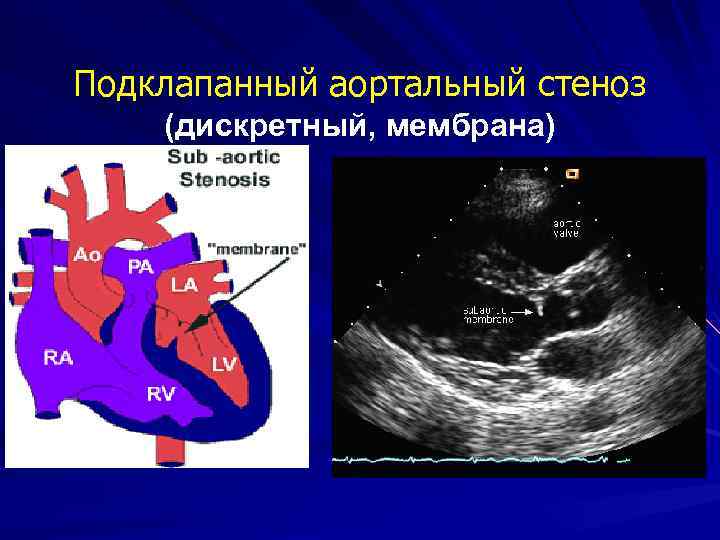 Подклапанный стеноз аортального клапана