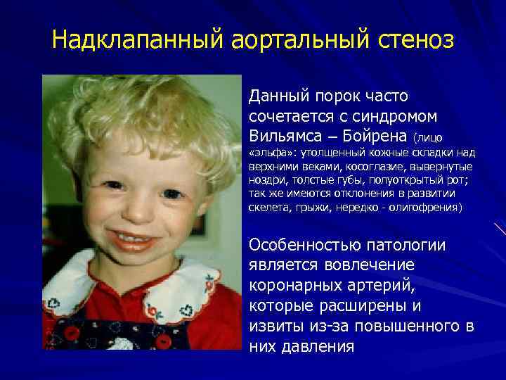 Надклапанный аортальный стеноз Данный порок часто сочетается с синдромом Вильямса – Бойрена (лицо «эльфа»