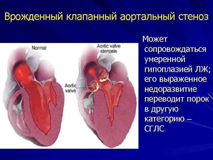 Стеноз аортального клапана симптомы