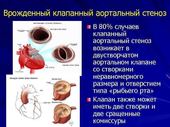 Стеноз аортального клапана симптомы