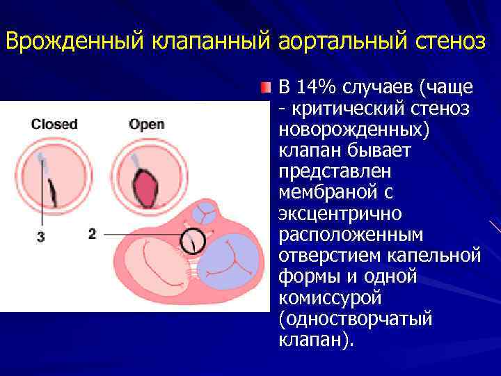 Аортальный клапан нормальные показатели