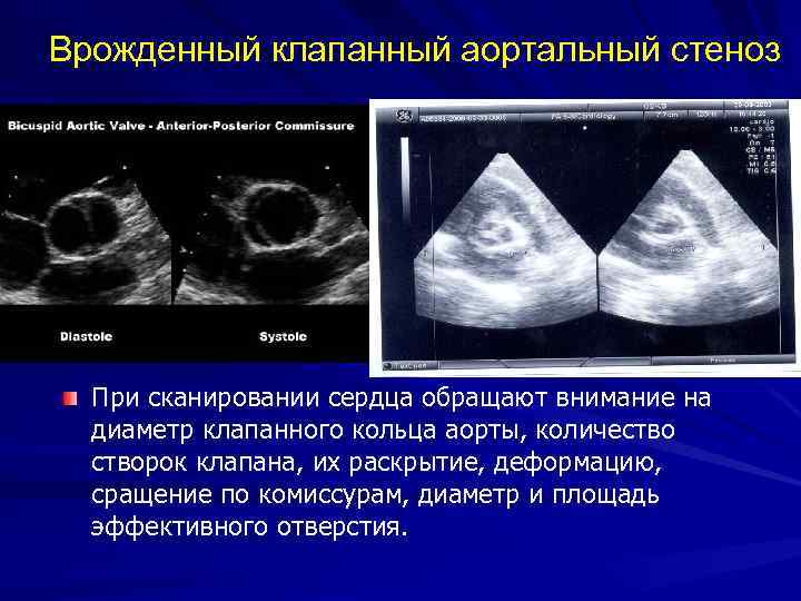 Аортальный клапан нормальные показатели