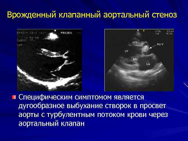 Врожденный клапанный аортальный стеноз Специфическим симптомом является дугообразное выбухание створок в просвет аорты с