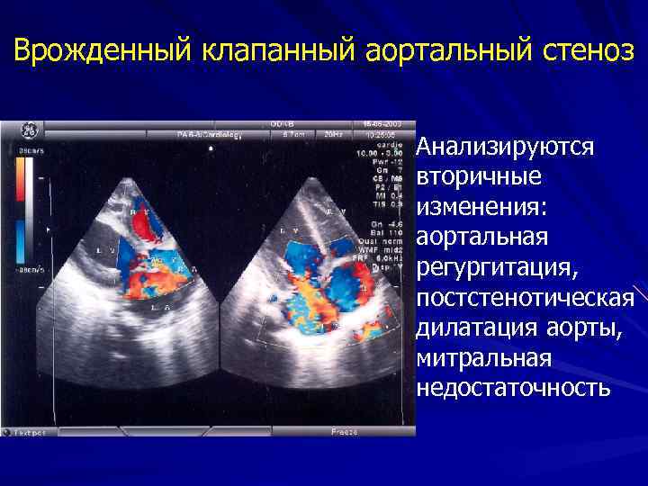 Врожденный клапанный аортальный стеноз Анализируются вторичные изменения: аортальная регургитация, постстенотическая дилатация аорты, митральная недостаточность