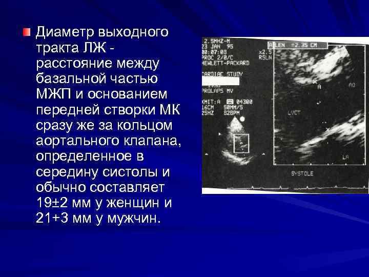 Диаметр выходного тракта ЛЖ расстояние между базальной частью МЖП и основанием передней створки МК