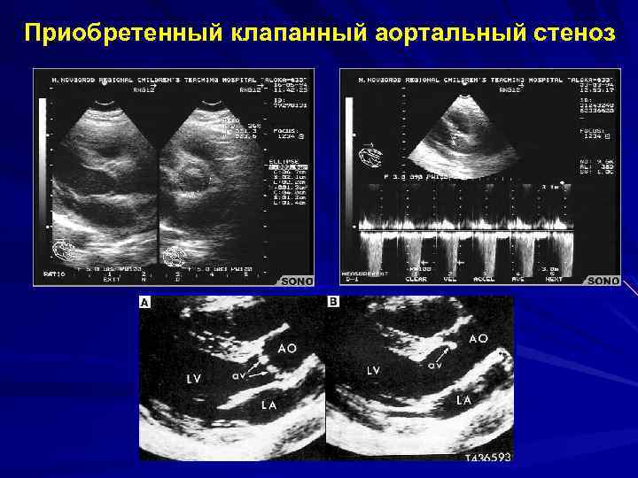 Аортальный клапан на узи