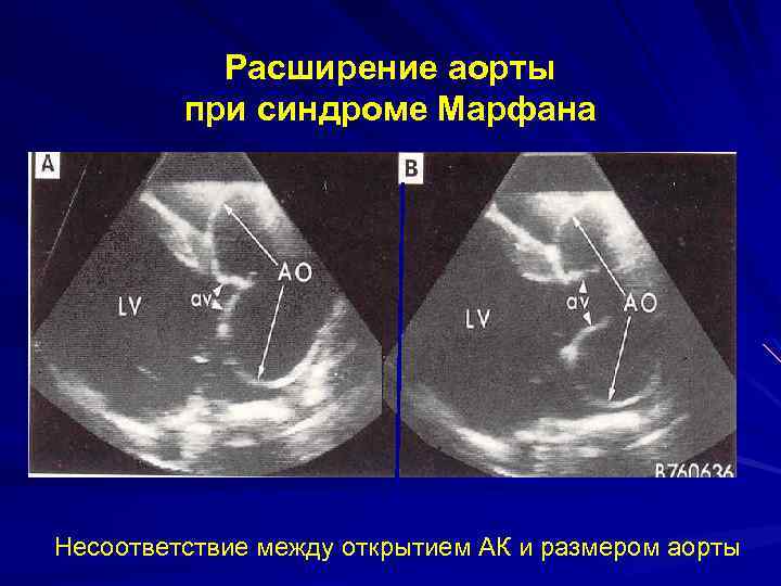 Легочный и аортальный клапан