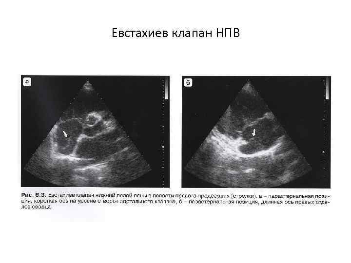 Евстахиев клапан НПВ 