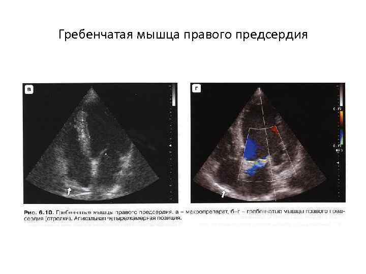 Гребенчатая мышца правого предсердия 