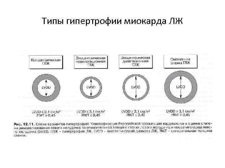 Типы гипертрофии миокарда ЛЖ 