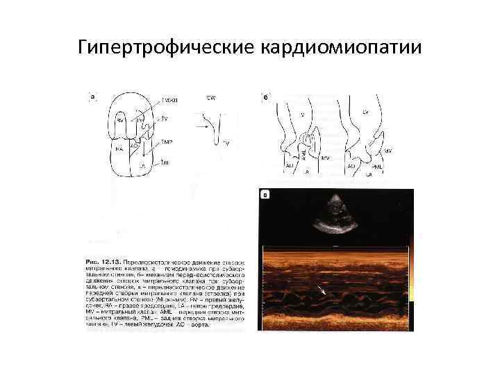 Гипертрофические кардиомиопатии 