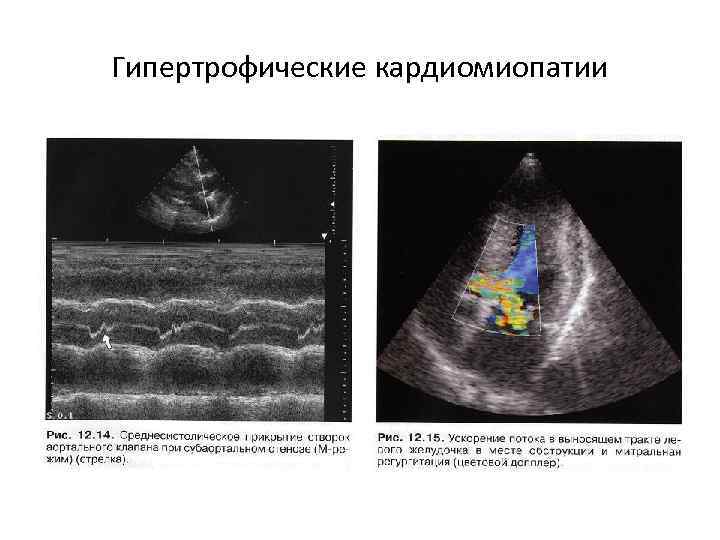 Гипертрофические кардиомиопатии 