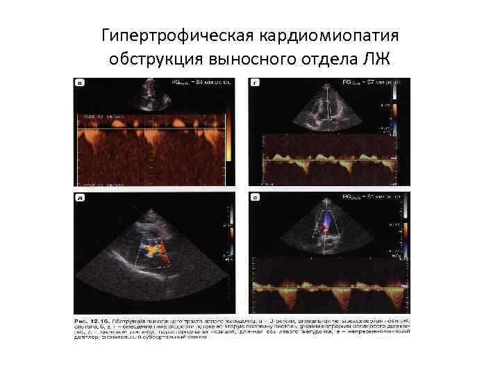 Гипертрофическая кардиомиопатия обструкция выносного отдела ЛЖ 