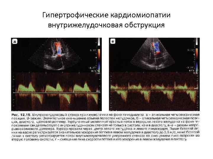 Гипертрофические кардиомиопатии внутрижелудочковая обструкция 