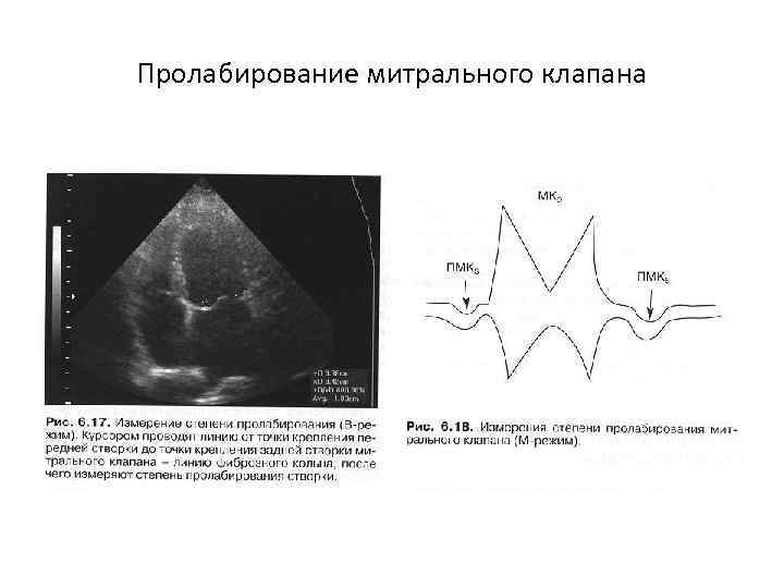 Пролабирование митрального клапана 