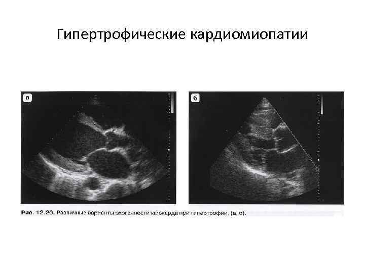 Гипертрофические кардиомиопатии 