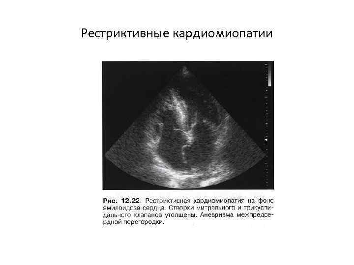 Рестриктивные кардиомиопатии 