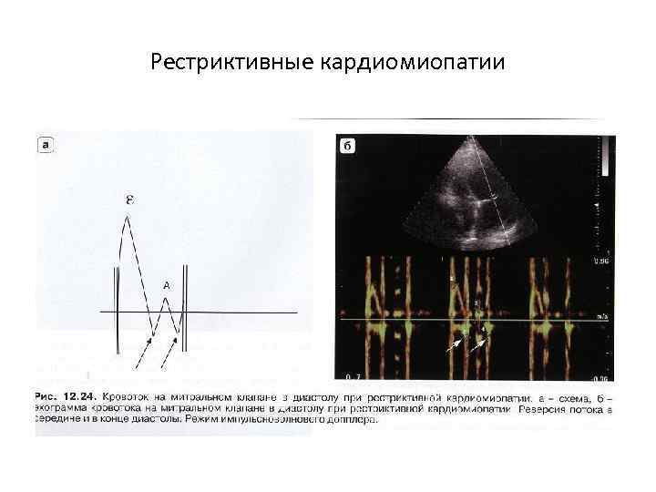 Рестриктивные кардиомиопатии 
