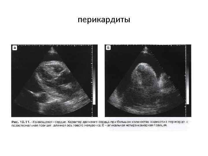 перикардиты 