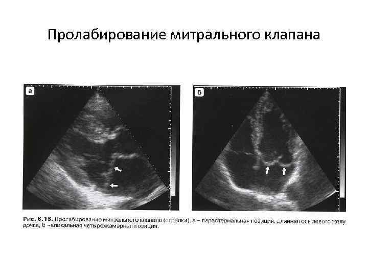 Пролабирование митрального клапана 