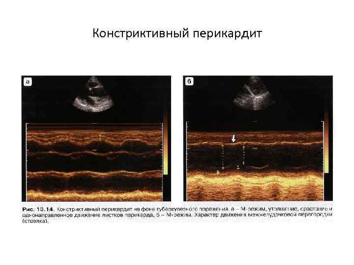 Констриктивный перикардит 