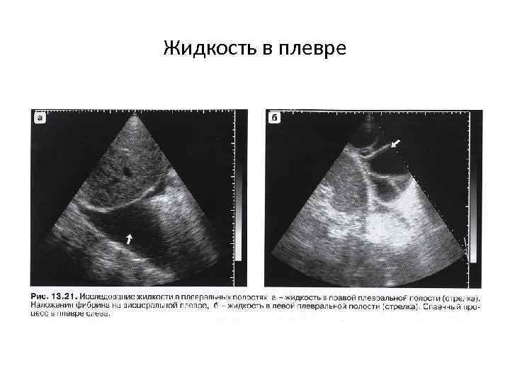 Жидкость в плевре 