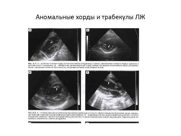 Аномальные хорды и трабекулы ЛЖ 