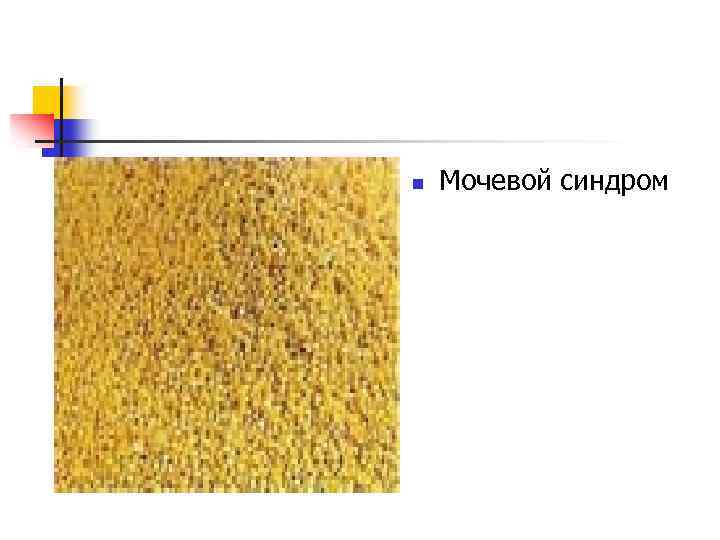 n Мочевой синдром 