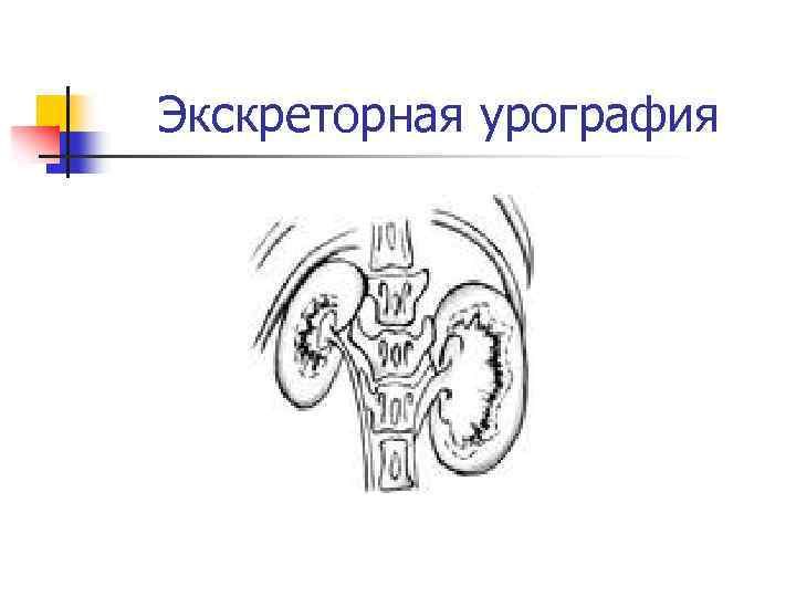 Экскреторная урография 
