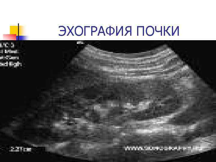 ЭХОГРАФИЯ ПОЧКИ 