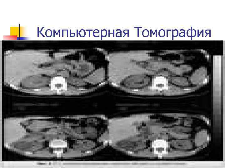 Компьютерная Томография 
