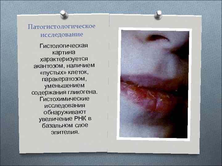 Патогистологическое исследование Гистологическая картина характеризуется акантозом, наличием «пустых» клеток, паракератозом, уменьшением содержания гликогена. Гистохимические