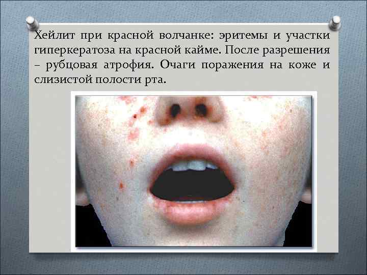 Хейлит при красной волчанке: эритемы и участки гиперкератоза на красной кайме. После разрешения –