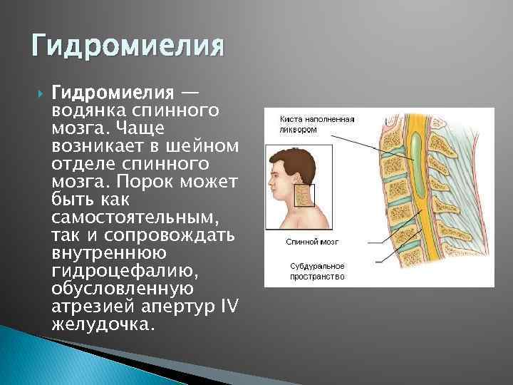 Гидромиелия — водянка спинного мозга. Чаще возникает в шейном отделе спинного мозга. Порок может