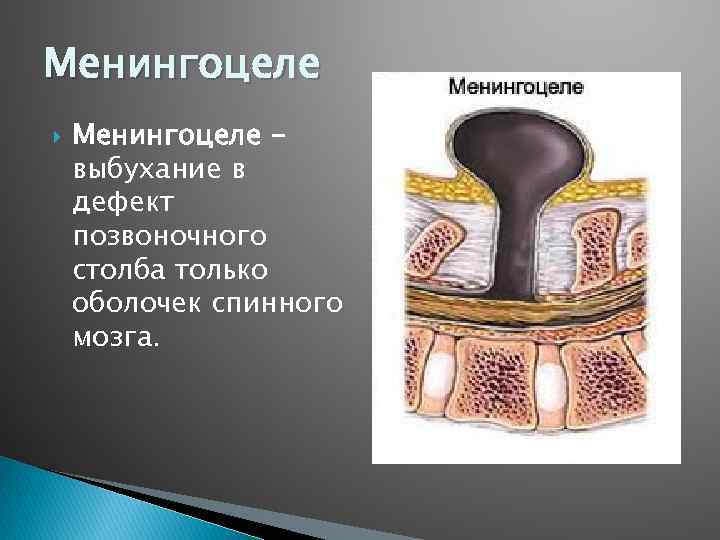 Менингоцеле выбухание в дефект позвоночного столба только оболочек спинного мозга. 