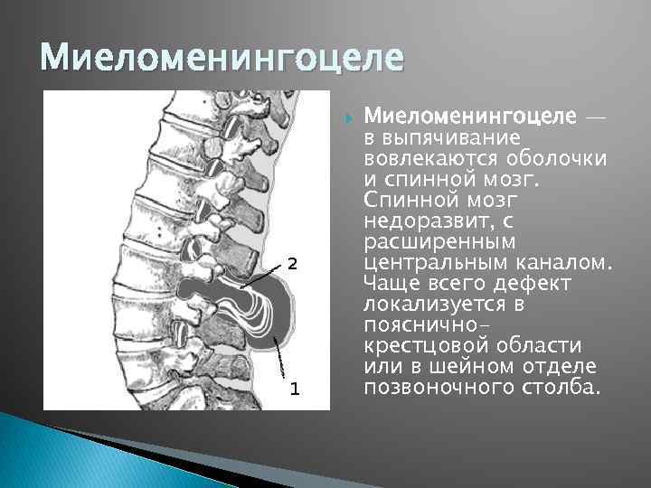 Миеломенингоцеле — в выпячивание вовлекаются оболочки и спинной мозг. Спинной мозг недоразвит, с расширенным